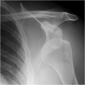 Shoulder dislocation not always a season ender