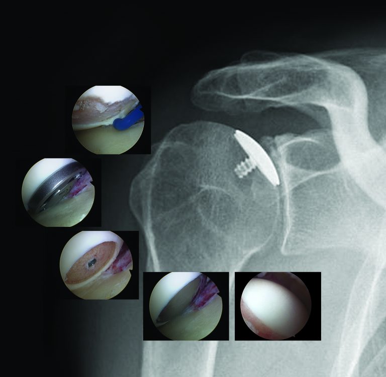 Orthopaedic pioneer, Dr. Steven Chudik, awarded patent for an arthroscopic total shoulder replacement surgery method