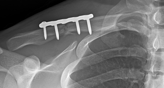 Dr. Steven Chudik, Orthopaedic Surgery and Sports Medicine Teaching and Research Foundation research on clavicle plate fixation comparison published in the Orthopaedic Journal of Sports Medicine