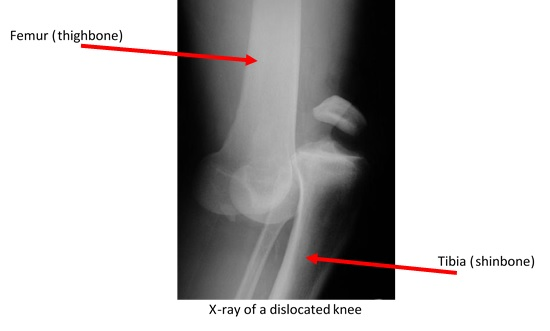 Knee dislocations in athletes like Bears tight end Zach Miller’s typically require complex, reconstructive surgery
