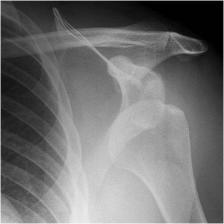 Arthroscopic expert, Dr. Steven Chudik, cites prompt treatment, thorough evaluation and physical therapy as key factors to successful return from shoulder dislocation injury