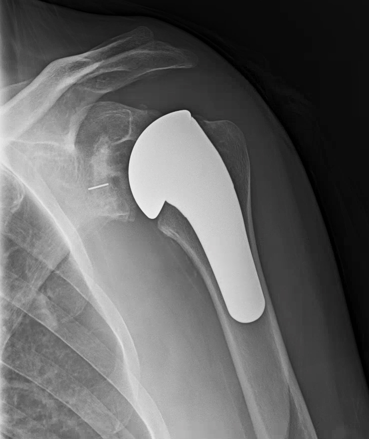 Dr. Steven Chudik keeps patients active with shoulder replacement surgery