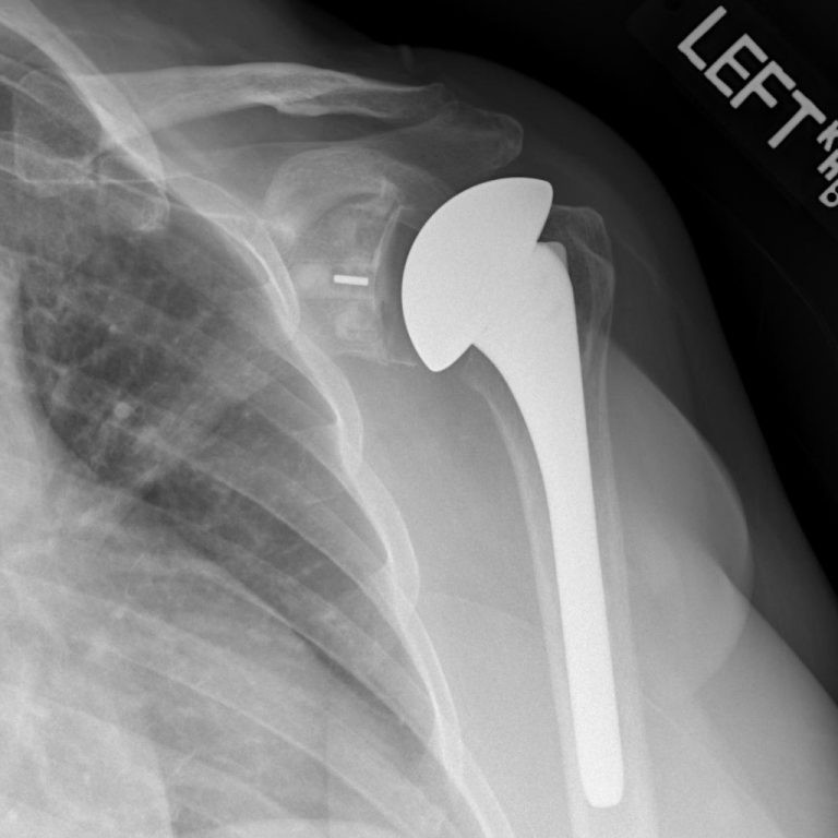 Shoulder replacement helps keep you in the game, not on the bench