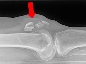 Susan Swanson’s determination to resume activities after a patella fracture drives need for a new surgical repair procedure