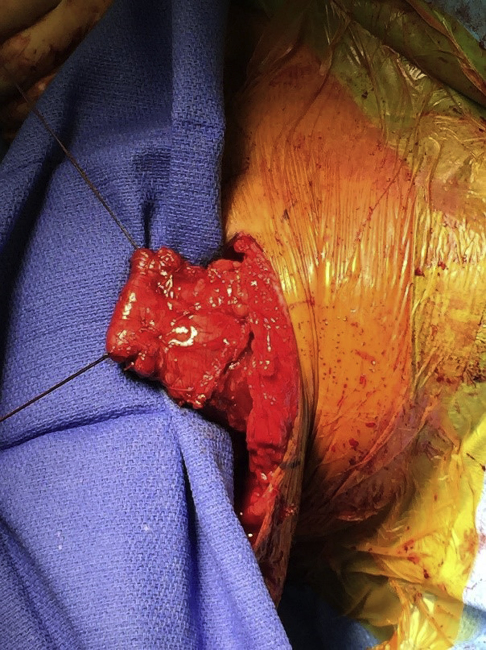 Dr. Steven Chudik’s OTRF research for a novel graft in pectoralis major tendon replacement surgery published
